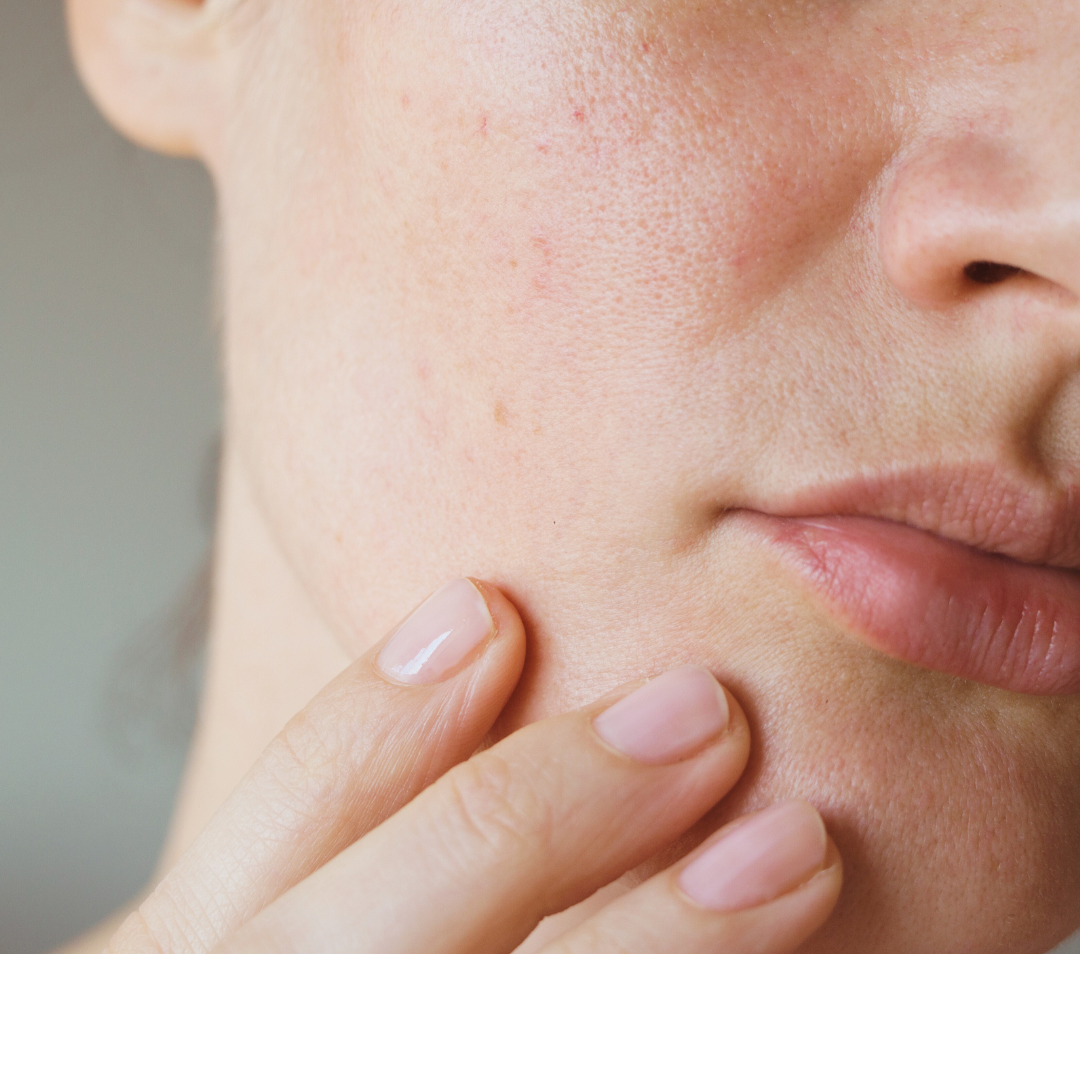 Erstverschlechterung (Skin Purging)